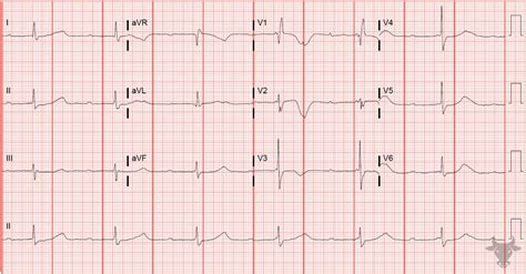 Third Degree Atrioventricular Block | ECG Stampede