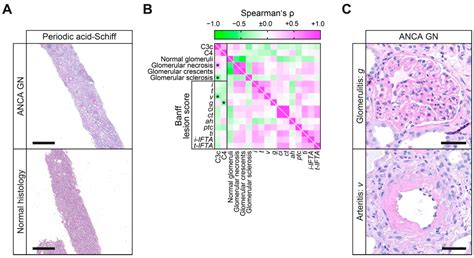Complement Components C3 and C4 Indicate Vasculitis Manifestations to Distinct Renal ...