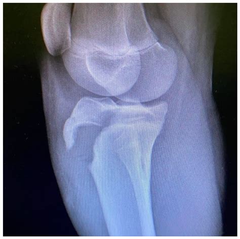 Tibial Tubercle Avulsion Fracture in Young Athletes Surgically Treated: Mid-Long Term Result and ...