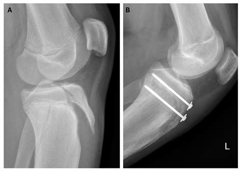 Association of Elevated Body Mass Index with Tibial Tuberosity Avulsion Fractures in Pediatric ...