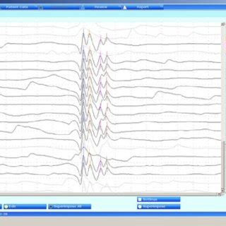 Image result for Single Fiber EMG Test