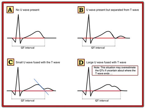 Online QTc Calculator for normal and wide QRS (LBBB, RBBB, etc.) - Dr ...