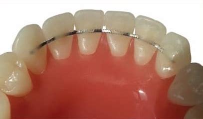 Image result for Retainer Problems