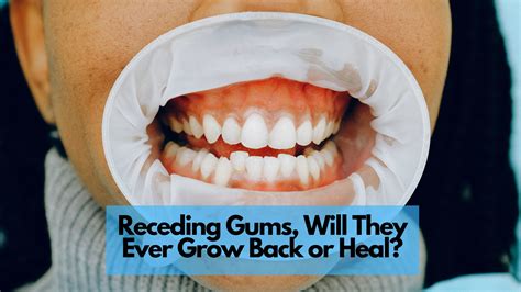 Broken Tooth Cutting Into Gum at Elmer May blog