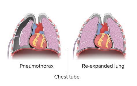 Chest X Ray Posteroanterior View Showing Left Hemo Pneumothorax Images2 View Chest X Ray