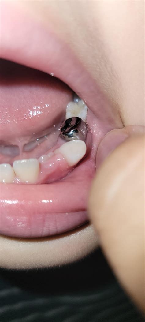 Son's permanent incisor pushing out baby canine : r/askdentists