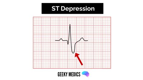 How to Read an ECG | ECG Interpretation | EKG | Geeky Medics