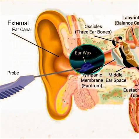 Ear Wax Removal With Molding at Mildred Fulcher blog