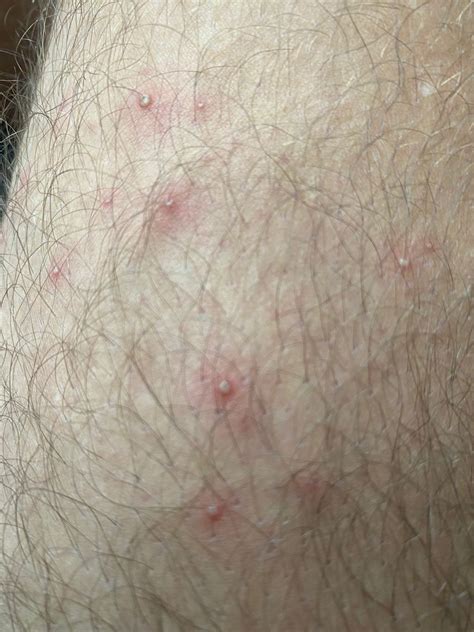 Pimple like bumps appeared in my legs overnight, does anybody know what it is? : r/Dermatology