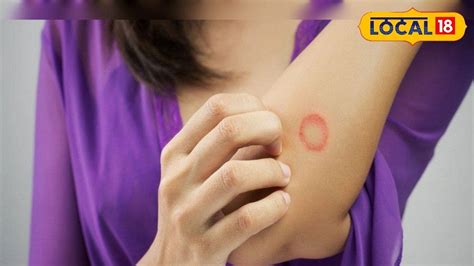Ringworm in Summer ডাক্তাররা একে 'টিনিয়া' বলে, আপনার শরীরের কোথাও এমন ...