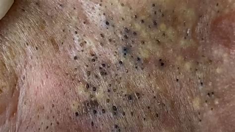 Pimple Popping Videos Blackheads