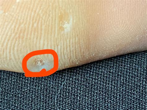 What Do Holes In The Bottom Of Your Feet Mean at Beulah Insley blog