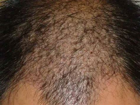 【图】男人脱发是什么原因？脱发的治疗方法是什么？_健康养生_健康-伊秀生活网|yxlady.com