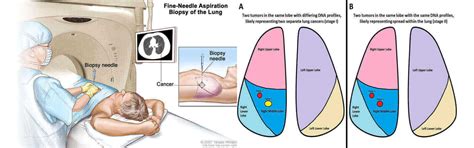 Lung Cancer Treatment In India