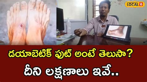 Diabetic Foot Symptoms | డయాబెటిక్ ఫుట్ అంటే ఏంటి? దీని లక్షణాలు ఇవే ...