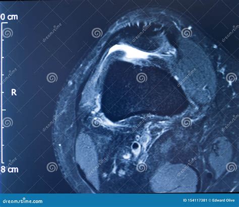 Knee injury mri mcl tear stock image. Image of health - 154117381