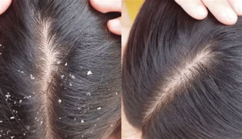 Anti Dandruff Treatment Salon, Hair Spa Dandruff - The Hair Corner ...