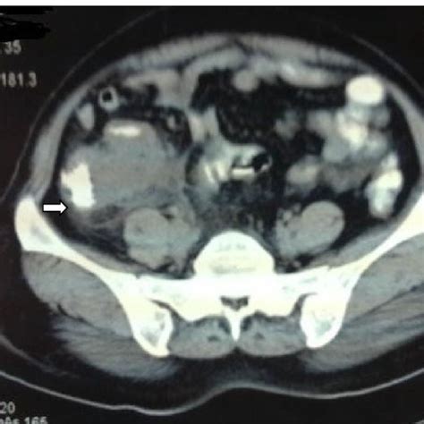 Image result for Normal Appendix Diameter