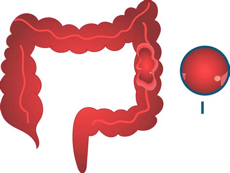 Kolon Kanseri 1. Evre Belirtileri