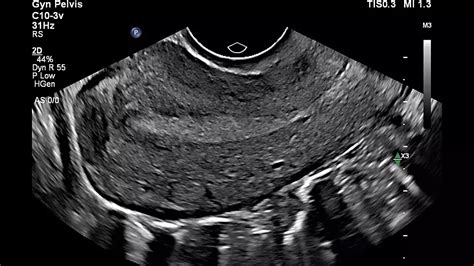 Gynecological ultrasound - Philips