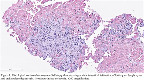GIANT CELL MYOCARDITIS AFTER MOGAMULIZUMAB | JACC
