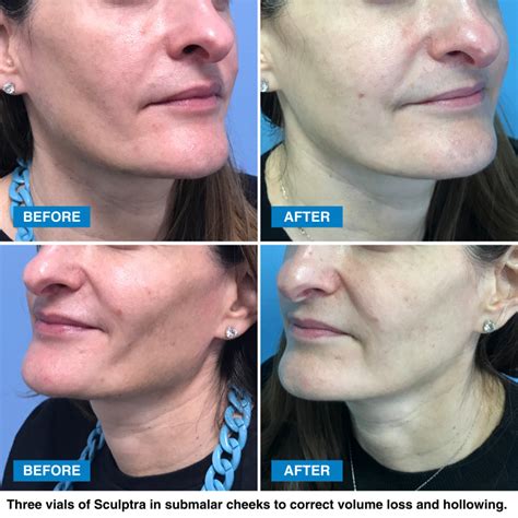 How Long Does Sculptra Last