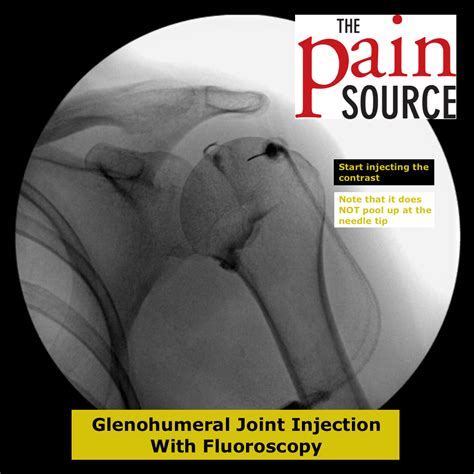 Image result for Shoulder Injection Fluoroscopy