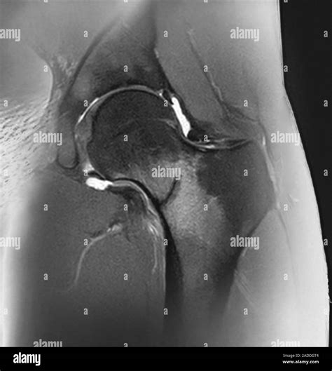 Hip stress fracture. Coronal magnetic resonance imaging (MRI) scan of the left hip of a 26-year ...