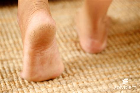 Cracked Heels: Causes, Prevention Tips & Treatment Options – Solvblem