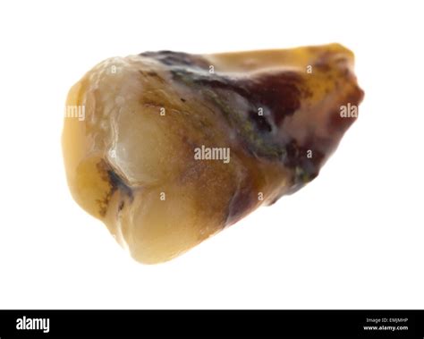 Image result for Wisdom Tooth Decayed