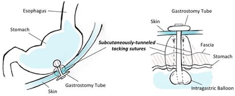 Sutures Used In Laparoscopic Surgery at Mae Kimbrell blog