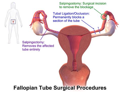 Tubal Ligation