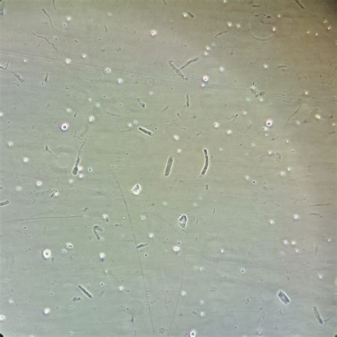 Urinary Casts: Identification & Significance