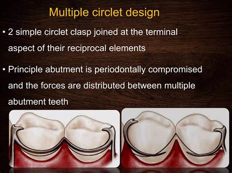 Image result for Clasp Method