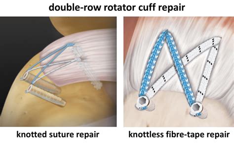 Image result for Single Row Rotator Cuff Repair