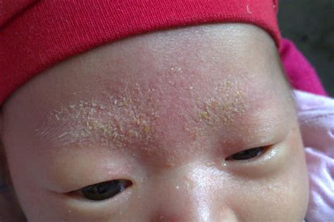 冬季，你以为给宝宝皮肤保湿就够了吗？ 到底怎么护理皮肤？__小豆苗疫苗助手