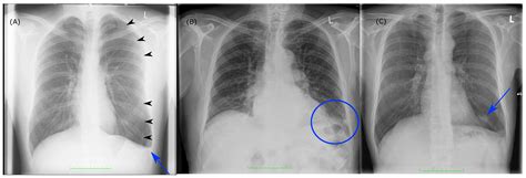 Interpretation of Thoracic Radiography Shows Large Discrepancies ...