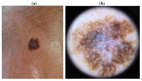 Melanoma Scalp
