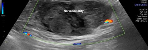 ACUTE RECTUS HEMATOMA – Case By Dr. Nitin Jadhav