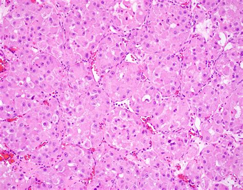 Pathology Outlines - Alveolar soft part sarcoma