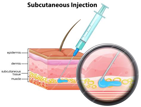 Subcutaneous injections | TransHub