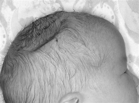 Depressed skull fracture in a newborn baby | ADC Fetal & Neonatal Edition