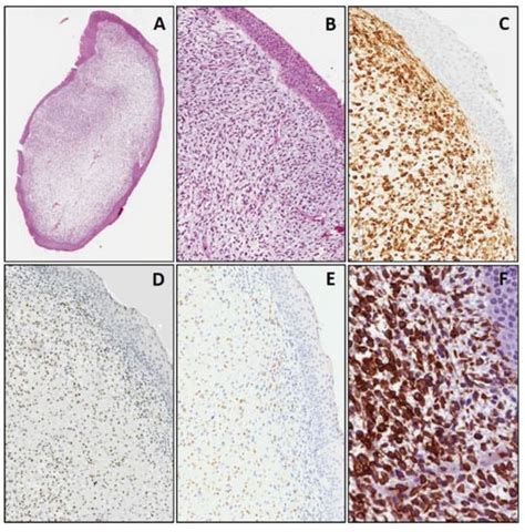 WT1 and Cyclin D1 Immunohistochemistry: A Useful Adjunct for Diagnosis ...