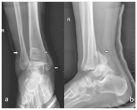 Pilon Fracture at Faith Fussell blog