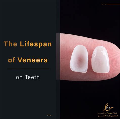 Lifespan Of Veneers