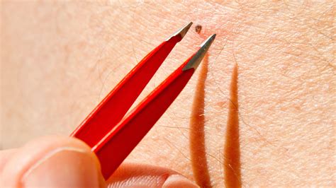 This Viral Video of a Six-Year-Old Ingrown Hair Being Removed Is Frightening | Allure