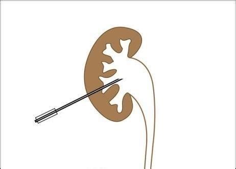 Percutaneous nephrostomy