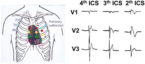 Brugada syndrome in Thailand: Three decades of progress - Heart Rhythm O2