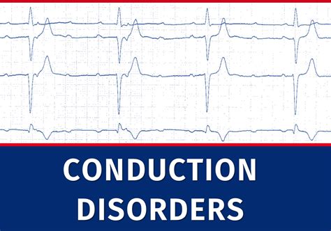 Image result for Cardiac Conduction Disorders Examples
