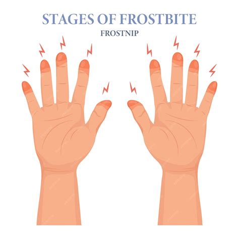 Premium Vector | Frozen hands in different stages. medical frostbite. stages of frostbite of ...